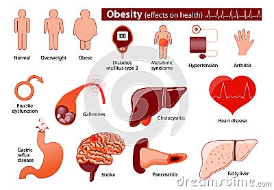 Obesity and overweight infographic Vector Illustration