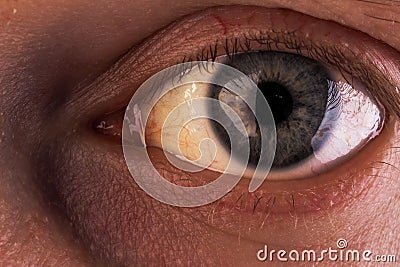 Obstructive Jaundice with severe yellowish discoloration of Eyes Stock Photo