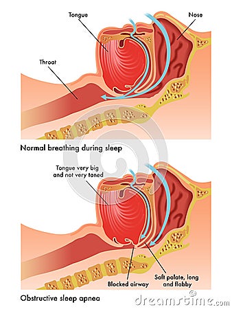 Obstructive sleep apnea Vector Illustration