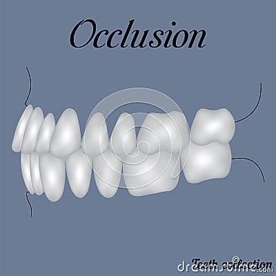 Occlusion side view Vector Illustration