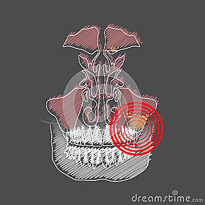 Stylized hatching of the Odontogenic sinusitis. Inflammation of the maxillary sinuses due to a disease of the roots of the tooth Stock Photo