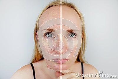 Oily skin and clear skin. Two photos before and after. Portrait of a girl with problem skin Stock Photo