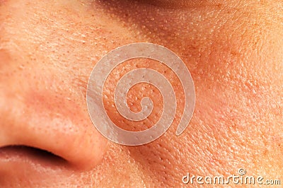 Oily skin on the face Stock Photo