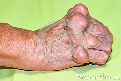 Old age and illnesses of pharmaceutical medicament severe gout in men suffering from joint pain, bone pain, gout ,arthritis ,arm, Stock Photo