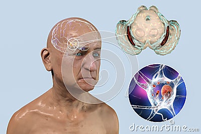 An old man with Parkinson's disease and highlighted brain and Black substance of the midbrain Cartoon Illustration