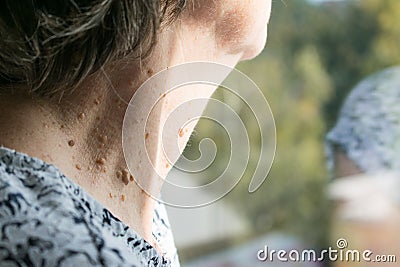 Old senior woman with skin problems closeup neck help and care Stock Photo