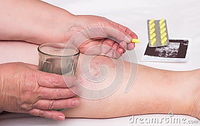 Old woman holding a glass of water and a pill for varicose veins on the background of the legs with varicose veins Stock Photo