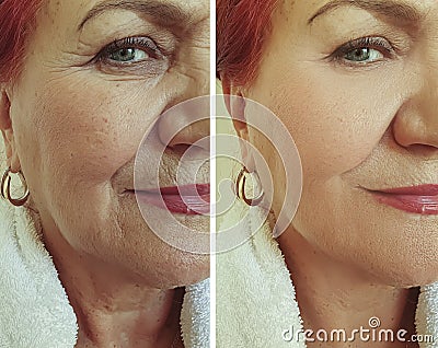 Old woman wrinkles face lift beautician before and effect correction after treatment Stock Photo