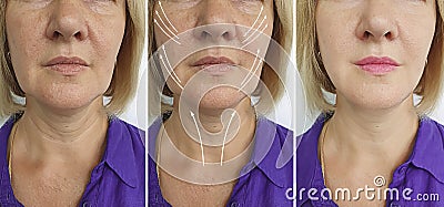 Old woman wrinkles tightening arrow sagging correction before after lifting plastic filler Stock Photo