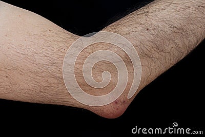Olecranon bursitis, also known as studentâ€™s elbow Stock Photo