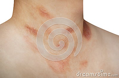 One person with Pityriasis rosea disease on the chest and neck Stock Photo