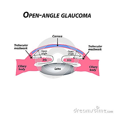 Open-angle glaucoma. A common type of glaucoma. The anatomical structure of the eye. Infographics. Vector illustration Vector Illustration