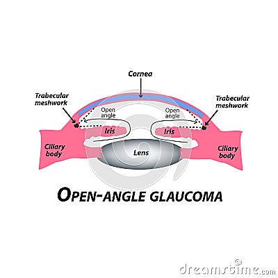 Open-angle glaucoma. A common type of glaucoma. The anatomical structure of the eye. Infographics. Vector illustration Vector Illustration