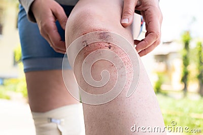 An open bleeding wound on the leg with cleansed skin, bruises and bruises. Damage to the legs during outdoor activities. Stock Photo