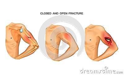 Open and closed fracture Vector Illustration