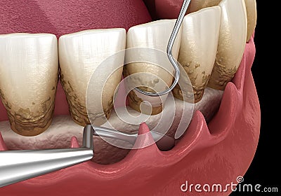 Open curettage: Scaling and root planing conventional periodontal therapy. Medically accurate 3D illustration of human teeth Cartoon Illustration