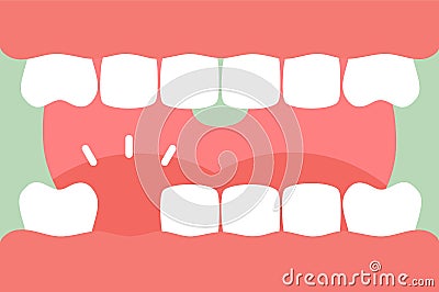 An open mouth with strong teeth and tongue and missing tooth Vector Illustration