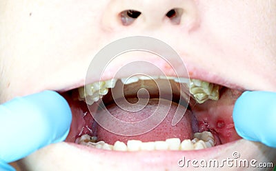 Operation removal of wisdom teeth - eights. Stitching, postoperative period Stock Photo