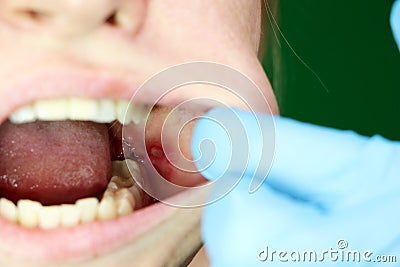 Painful ulcer and stomatitis on the mucous cheek of a girl. After the operation to remove the wisdom teeth. Stitches and Stock Photo