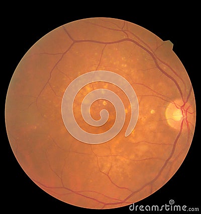 Ophthalmic image detailing the retina and optic nerve inside a healthy human eye. Health protection concept Stock Photo