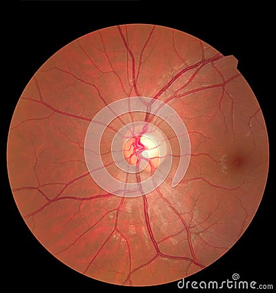 Ophthalmic image detailing the retina and optic nerve inside a healthy human eye. Health protection concept Stock Photo