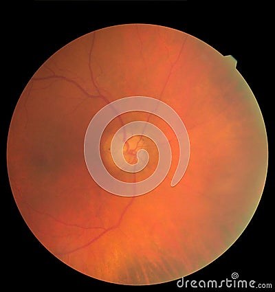 Ophthalmic image detailing the retina and optic nerve inside a healthy human eye. Medicine concept Stock Photo