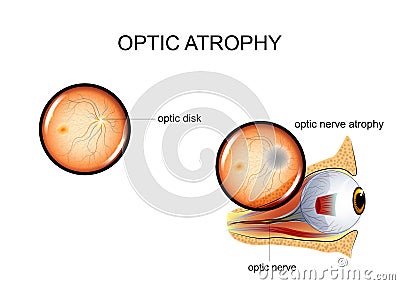 Optic nerve atrophy Vector Illustration