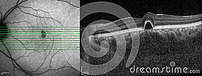 Optical Coherence Tomography Stock Photo