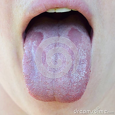 Oral Candidiasis or Oral trush Candida albicans, yeast infection on the human tongue close up, common side effect when using a Stock Photo