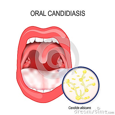 Oral candidiasis. yeast infection ofl Candida albicans the mouth Vector Illustration