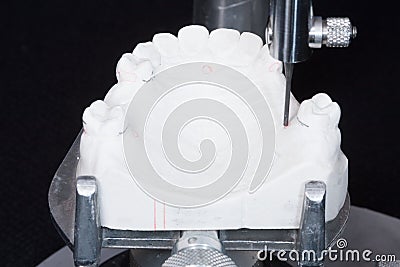 Oral rehabilitation process, partial removable prosthesis Stock Photo