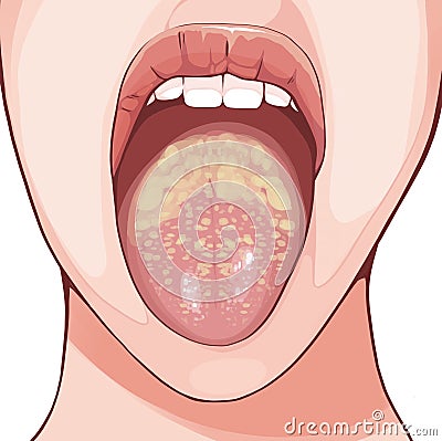 Oral thrush is an infection caused by the Candida albicans fungus. Cartoon Illustration