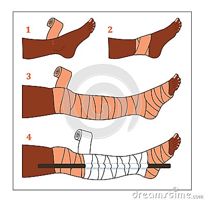 Common first aid situation - Snake bite Stock Photo