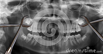 Orthodontic tools and wisdom teeth Stock Photo