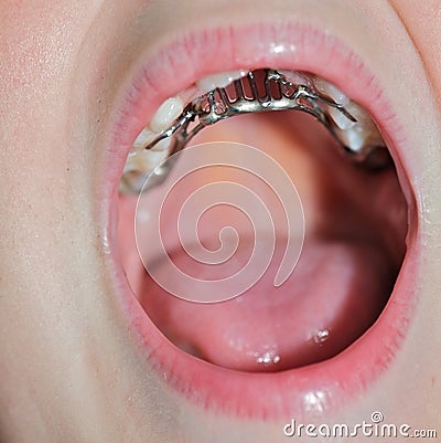 Orthodontics Stock Photo