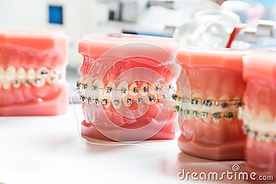 Orthodontics dental braces on teeth model to align teeth Stock Photo