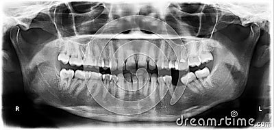 Orthopantomogram of the dentition Stock Photo