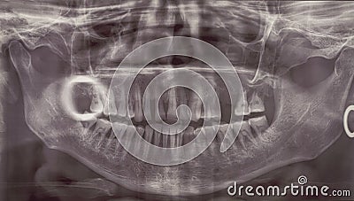 Orthopantomogram. Panoramic dental x-ray of an adult person Stock Photo