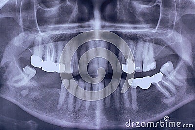 Orthopantomography of an adult patient , panoramic x-ray. dental Stock Photo