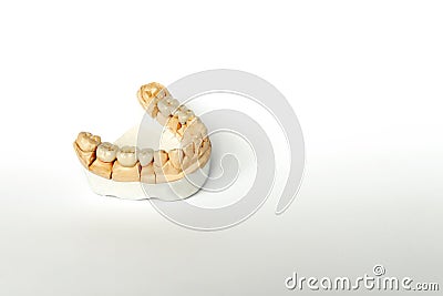 Orthopedic dentistry. tooth replacement concept. dental prosthetics. cermet teeth. ceramic bridges. gypsum model of the jaw and Stock Photo