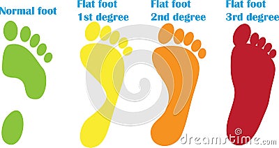 Orthopedic steps of flat foot Stock Photo