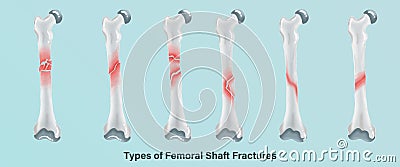 Orthopedics of Types of Femoral Shaft Fractures Vector Illustration