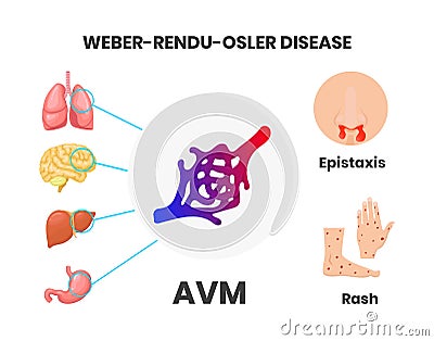 Osler-Rendu-Weber disease signs and symptoms Vector Illustration