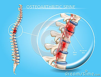 Spinal Osteoarthritis Realistic Vector Concept Vector Illustration