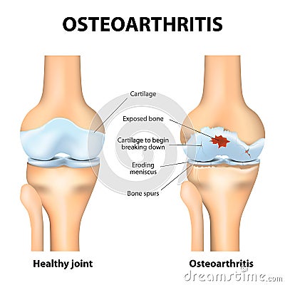 Osteoarthritis or arthritis Vector Illustration