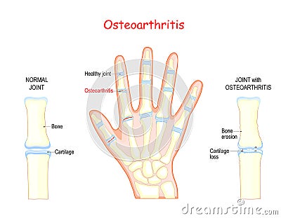 Osteoarthritis. Bones of a human hand Vector Illustration