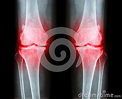 Osteoarthritis both knee . film x-ray AP anterior - posterior of knee show narrow joint space , osteophyte spur , subcond Stock Photo