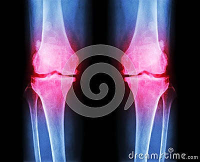 Osteoarthritis both knee . film x-ray AP ( anterior - posterior ) of knee show narrow joint space , osteophyte ( spur ) , subcond Stock Photo