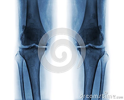 Osteoarthritis both knee . Stock Photo