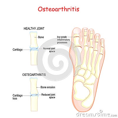 Osteoarthritis. comparison healthy joint and inflammation joint Vector Illustration